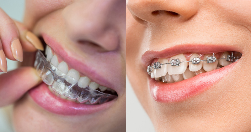 Know About the Difference Between Braces and Clear Aligners